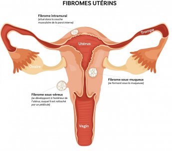 Uterus et localistation de fibromes