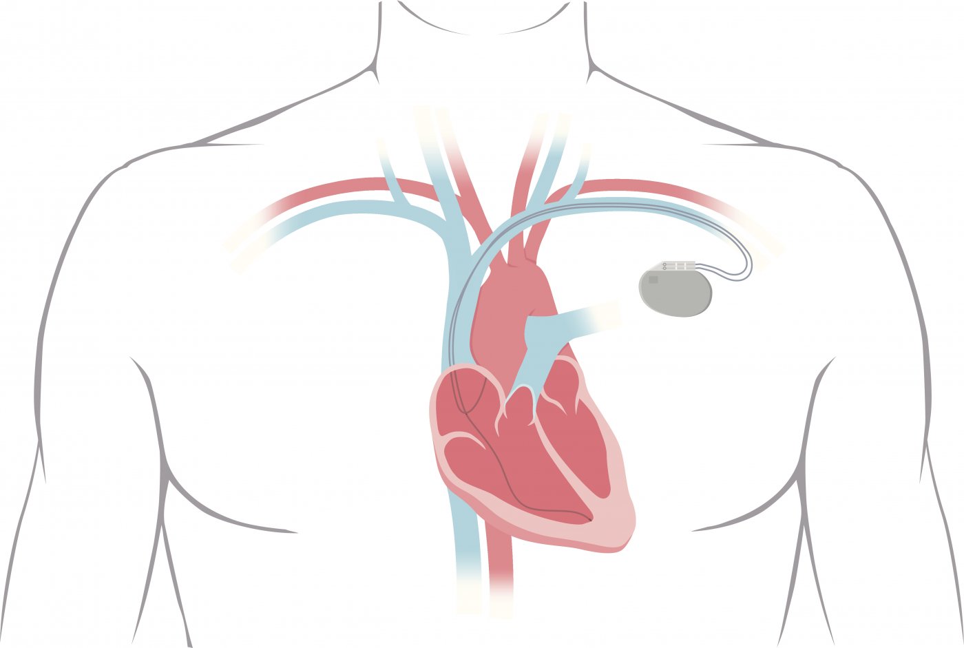 Implantation d'un stimulateur ou d'un défibrillateur cardiaque ...