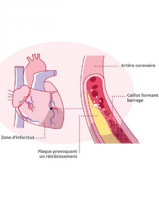 Atherome coronaire