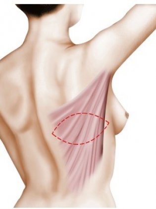 Reconstruction mammaire par lambeau de grand dorsal