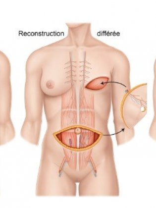 La reconstruction mammaire après mastectomie | American Hospital ...