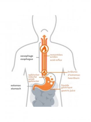 reflux gastro-oesophagien