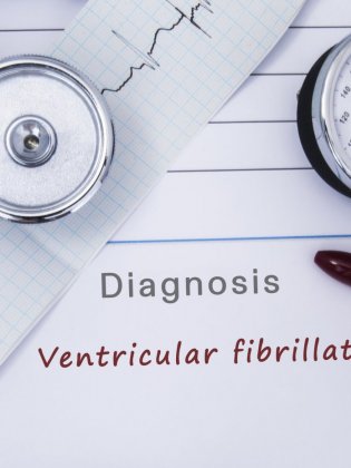 Fibrillation ventriculaire