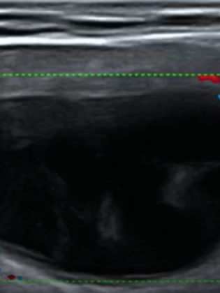 Images échographiques de kystes thyroïdiens purs