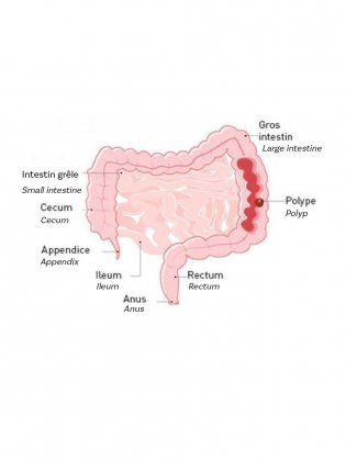 rectal polypectomy