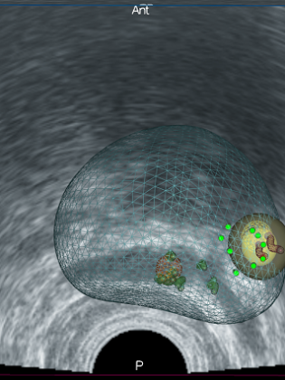 Traitement ciblé cancer de la prostate