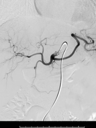 embolisation hopital américain de paris