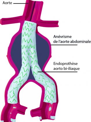 endoprothèse aorto bi-iliaque