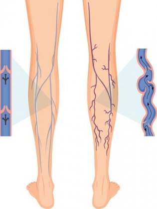 varices