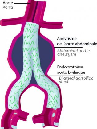 endoprothèse aorto bi-iliaque