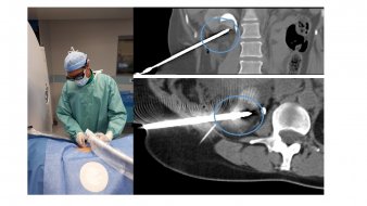 Destruction du cancer du rein sans chirurgie