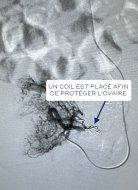 embolisation adenmyose fertilité