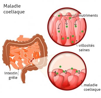 Maladie coeliaque