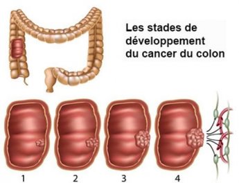 Les stades de développement du cancer du côlon