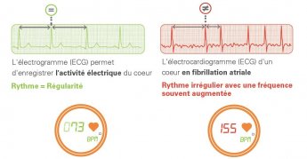 Comparaison du rythme cardiaque d'un cœur sain et d'un cœur en fibrillation cardiaque.