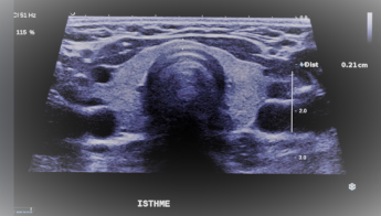 Image échographique d'une thyroïde normale