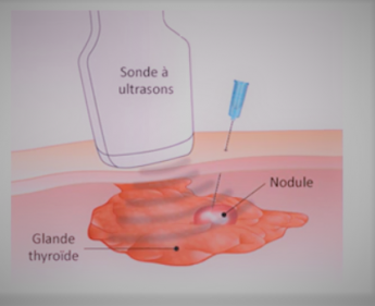 Modalités de réalisation d'une cytoponction thyroïdienne