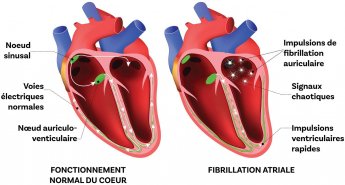 Schéma montrant le fonctionnement d'un coeur sain au côté d'un coeur atteint de fibrillation atriale. 