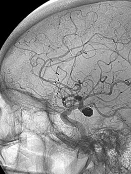 Embolisation Hôpital Américain de Paris