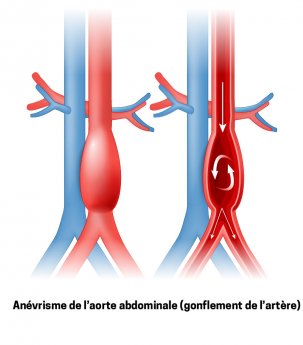 anévrisme aorte abdominale