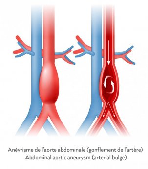 anévrisme aorte abdominale