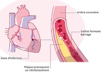 Atherome coronaire