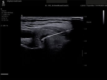 Image échographique thermo-ablation