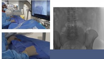 Example of uterine fibroid embolization